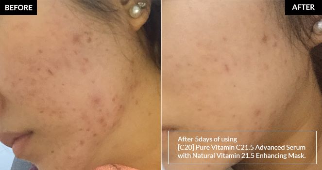 Làn da trước và sau sử dụng Vitamin C 21.5% Advanced