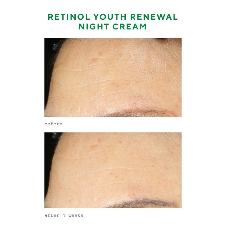 Hiệu quả trước và sau Retinol Renewal Night Cream